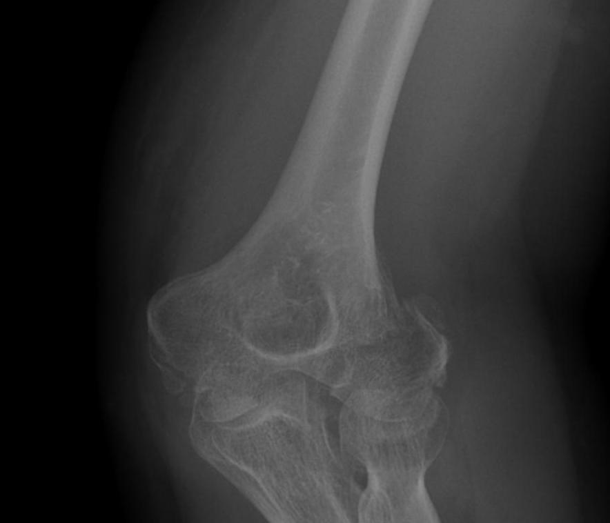 Elbow Lateral Condyle Fracture